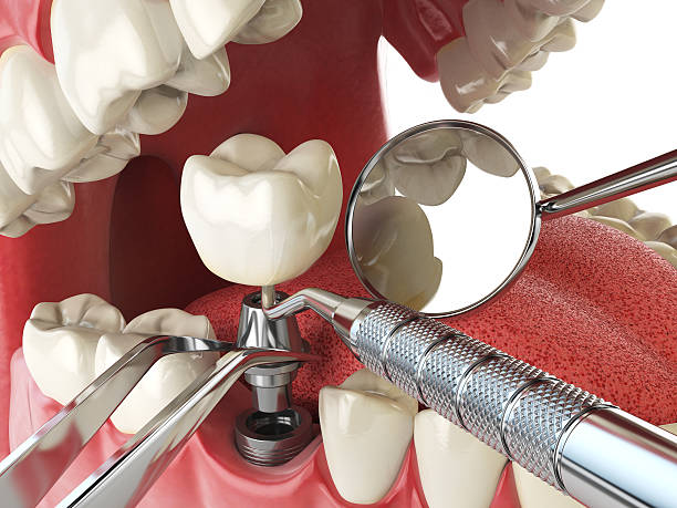 Best Emergency Dentist for Knocked-Out Tooth in University City, MO